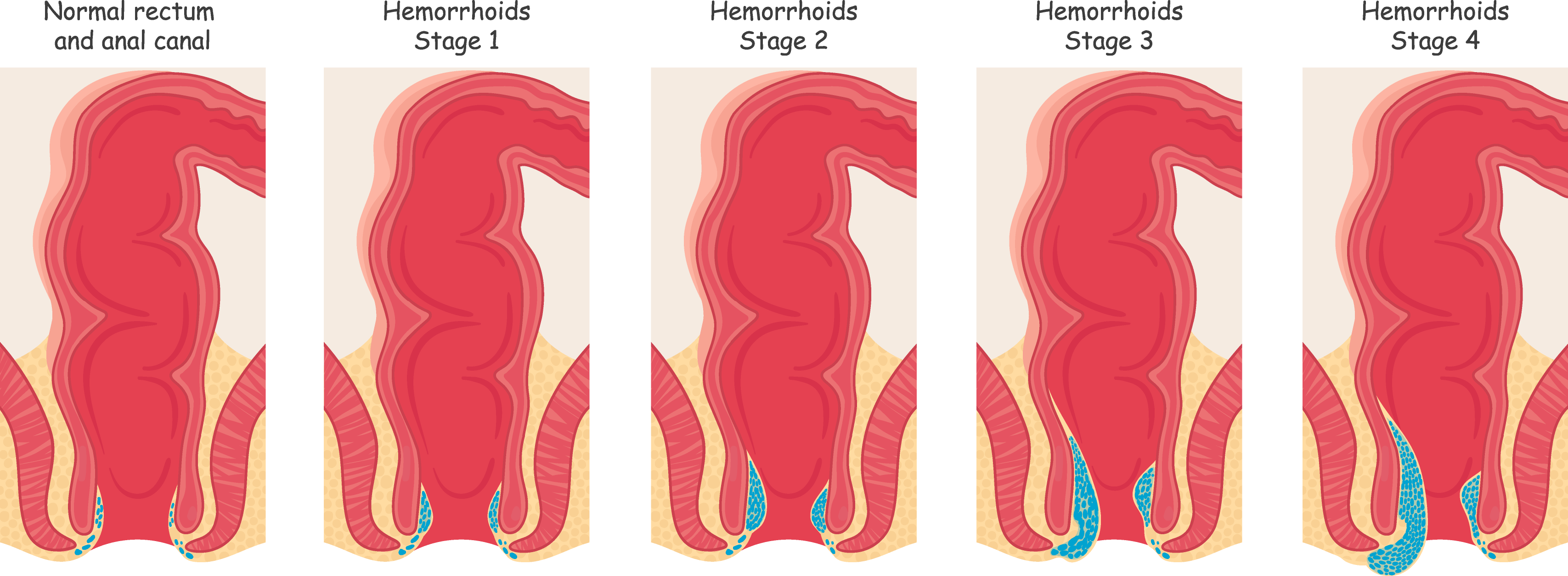 Hemorrhoids