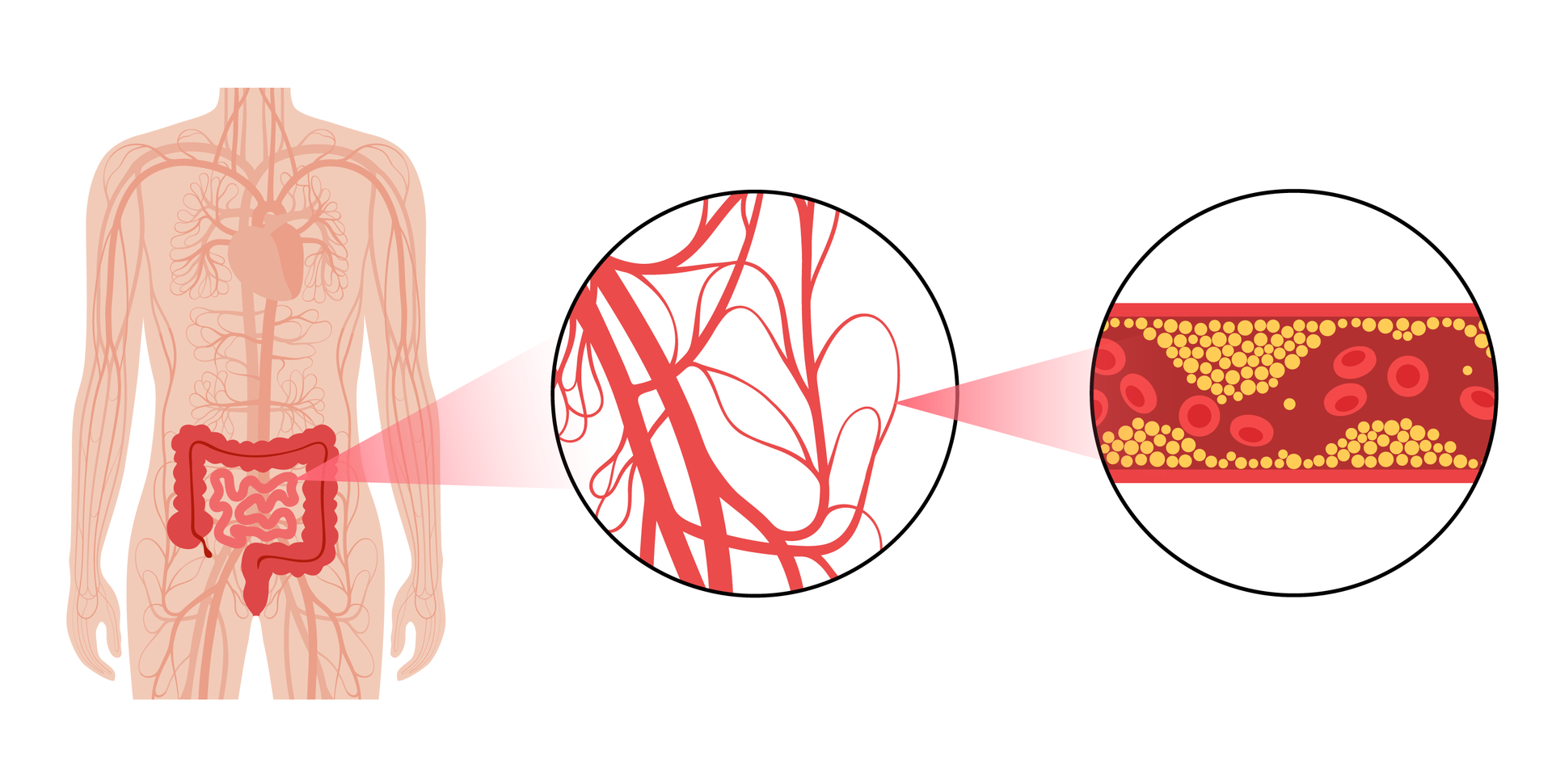Mesenteric Ischemia