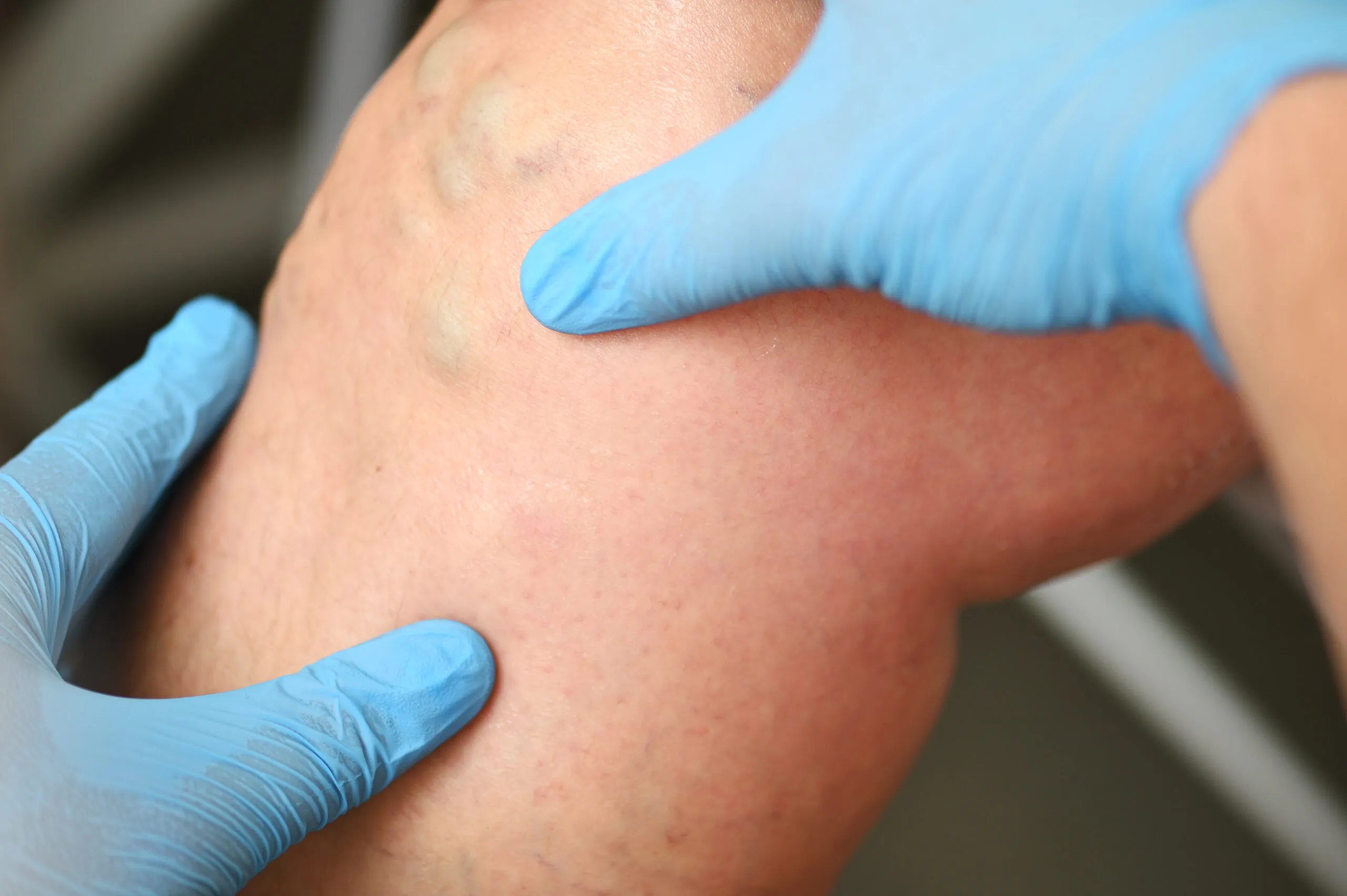 Varicose Veins